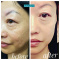 Best Acne Treatment