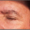 Avail Of Professional Blemish Removal Product at a Price of $100
